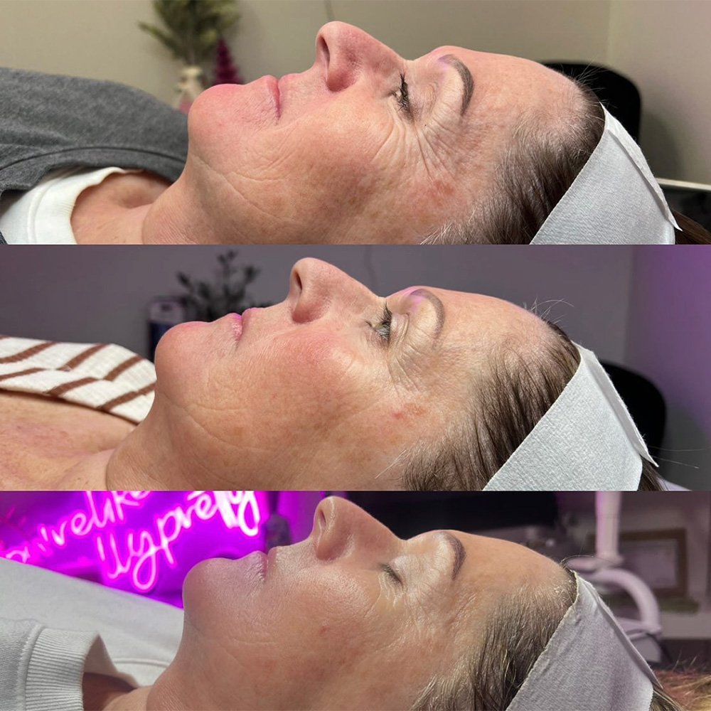 procell-before-after-1