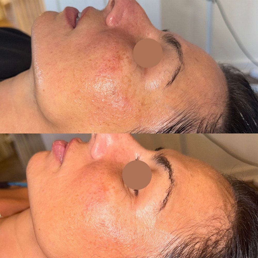 procell-before-after-10