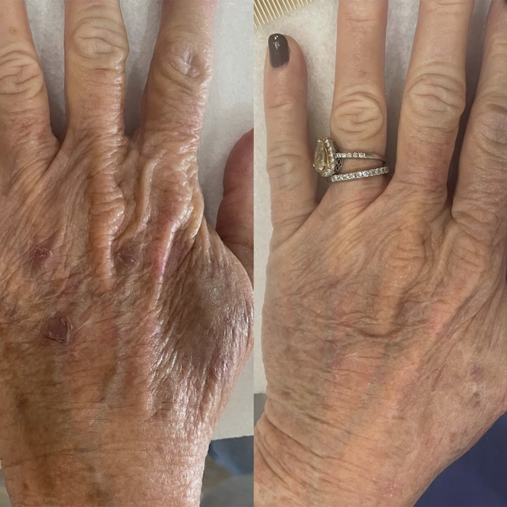 procell-before-after-2