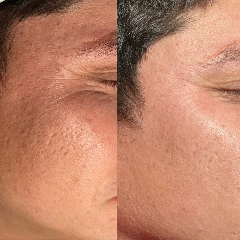 procell-before-after-4